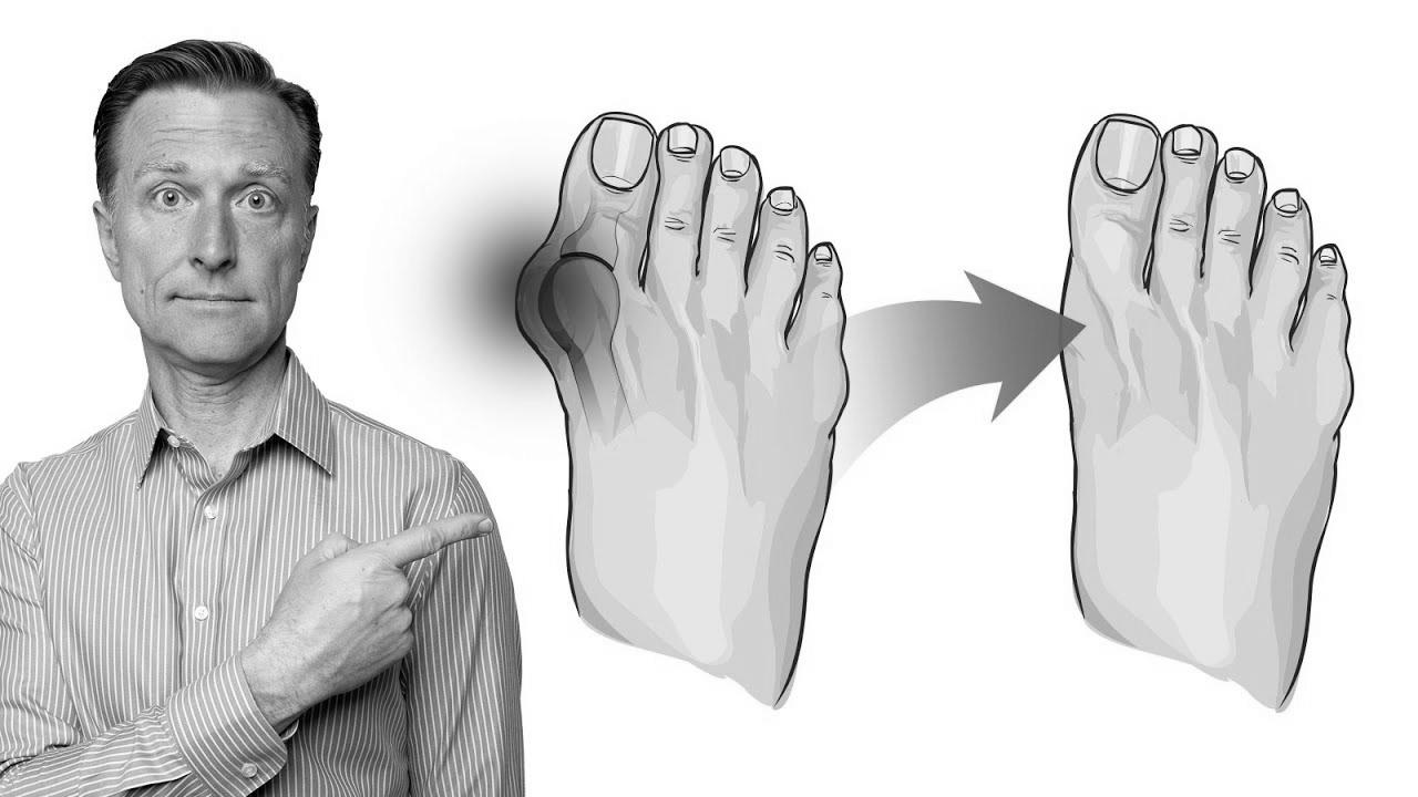 How you can Repair Bunions in 3 Steps