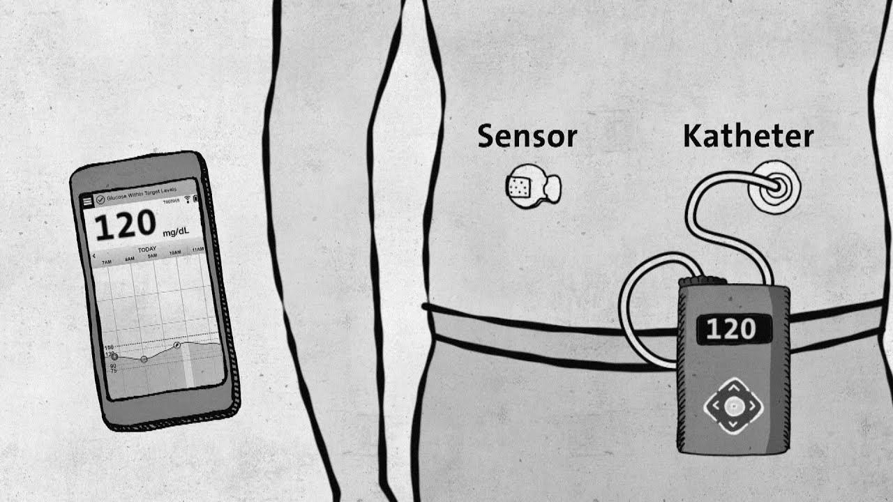 Kind 1 diabetes – modern expertise without approval – good to know